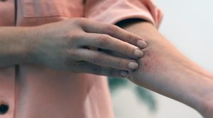 Verano sin riesgos: cómo actuar ante una picadura